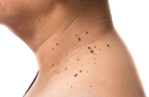 Psoriasis